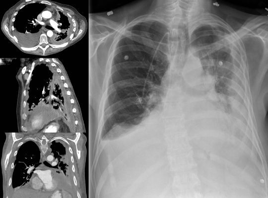 Sick Lungs Xray | Featured image Famous Cases of Mesothelioma Asbestos in The World from Asbestos Removals Brisbane.